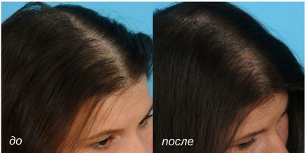 Мезотерапія для росту волосся голови як проводиться процедура, який ефект після