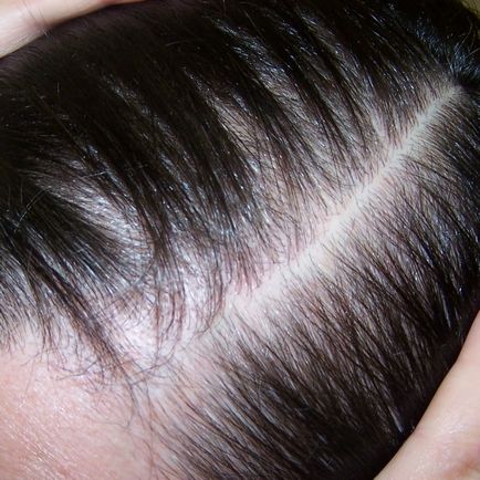 Mezoterapia scalpului la Moscova, recenzii, preturi, fotografii inainte si dupa, video
