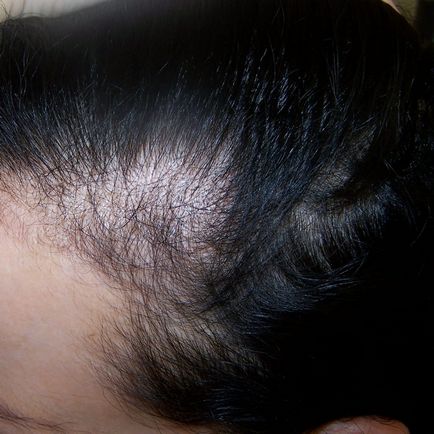 Мезотерапія волосистої частини голови в Москві, відгуки, ціни, фото до і після, відео