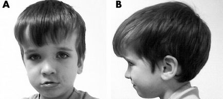 Microcefalia la copii