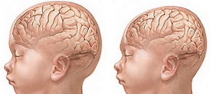 Microcefalia la copii