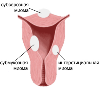 Міома матки симптоми, лікування, операція