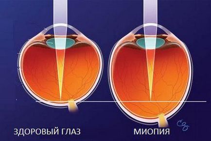 nagy myopia