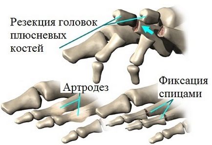 Молоткообразная деформація пальців стопи лікування в москві, операції молоткообразних пальцях ніг
