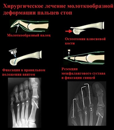Deformarea în formă de ciocan a degetelor de la picioarele de la Moscova, operații ale degetelor în formă de ciocan