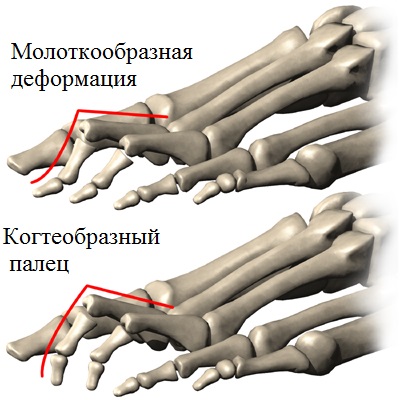 Молоткообразная деформація пальців стопи лікування в москві, операції молоткообразних пальцях ніг