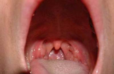 Indiferent dacă este posibil să se gargă un gât cu furazilinom în timpul sarcinii și dacă există caracteristici