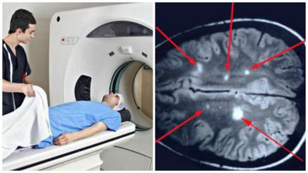 MRI sclerosis multiplexben a betegség tünetei és diagnózisa