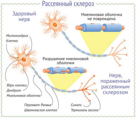 Domnul în caz de semne multiple de scleroză a bolii și diagnosticul acesteia