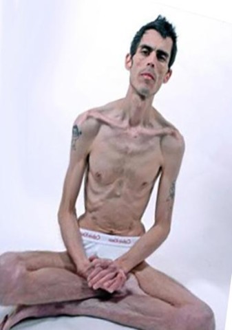 Férfi anorexia