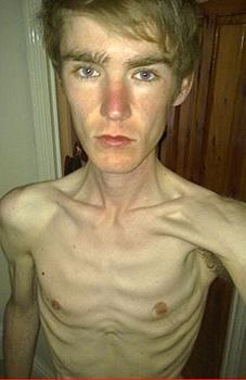 Men anorexia (étvágytalanság férfiaknál fotó) Férfi anorexia