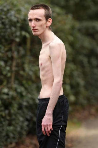 Férfi anorexia