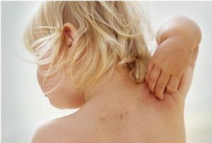 Remedii populare pentru alergii la copii pe piele - remedii populare