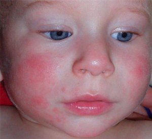 Народні засоби від алергії у дітей на шкірі - народні засоби