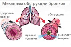 Probleme de obstrucție bronhială și tratament