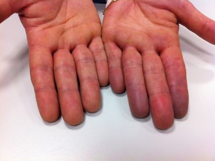 Amorțirea degetului mic al mâinii stângi cauzează și vindecă