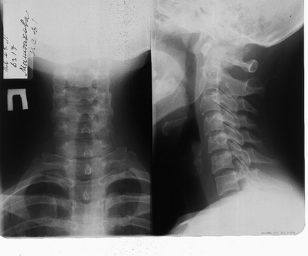 Operații cu hernie a coloanei vertebrale cervicale