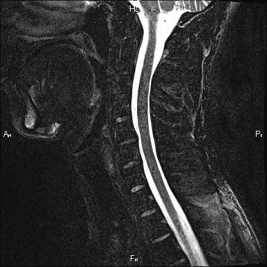 Operații cu hernie a coloanei vertebrale cervicale