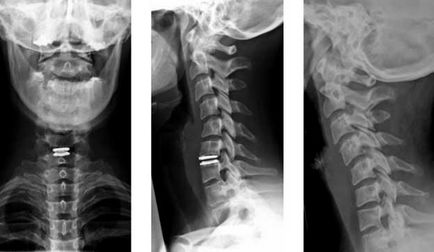 Operații cu hernie a coloanei vertebrale cervicale