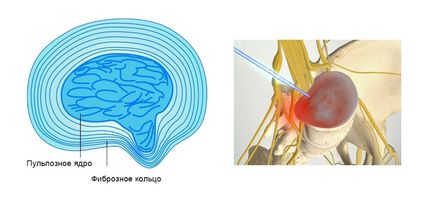 Operații cu hernie a coloanei vertebrale cervicale