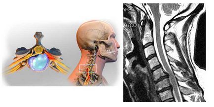 Operații cu hernie a coloanei vertebrale cervicale