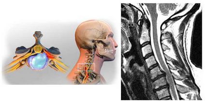 Műtét sérv a nyaki gerinc