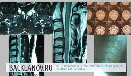 Operații cu hernie a coloanei vertebrale cervicale