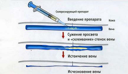 Ускладнення склеротерапії вен і побічні ефекти синці, плями, ущільнення