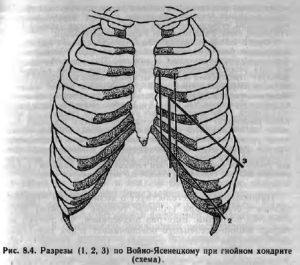 Osteomielita din stern, coaste, chondrite purulente, chirurgi ro