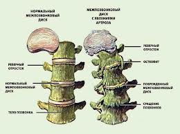 Osteochondroza și sciatica - și lipitorii vă vor ajuta! Hirudoterapia - tratament cu lipitori - interesante și