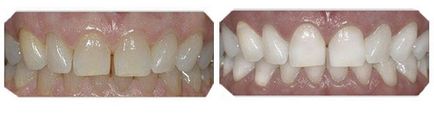 Відбілювання зубів yotuel - як провести безпечне відбілювання зубів йотуель