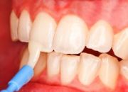 Відбілювання зубів yotuel - щадна прогресивна система