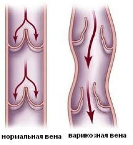 Umflarea extremităților inferioare cauze, metode de a scăpa de