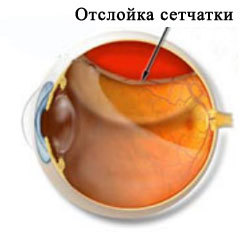 Відшарування сітківки ока ознаки, симптоми і лікування відшарування сітківки - профілактика лікування