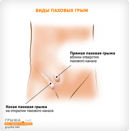 Пахова грижа симптоми і види