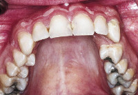 Fractura procesului alveolar - cauze, simptome, diagnostic și tratament