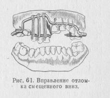 Fracturile proceselor maxilarului superior, ghidul medicului