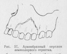 Fracturile proceselor maxilarului superior, ghidul medicului