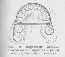 Fracturile proceselor maxilarului superior, ghidul medicului