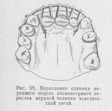 Fracturile proceselor maxilarului superior, ghidul medicului