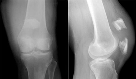 Fractura mecanismului de dezvoltare a articulatiei genunchiului, diagnostic, tratament