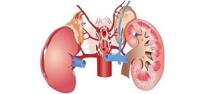 Pyeloelectazia rinichilor ce trebuie făcută dacă dilatați pelvisul