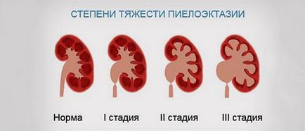 Pyeloelectazia rinichilor ce trebuie făcută dacă dilatați pelvisul