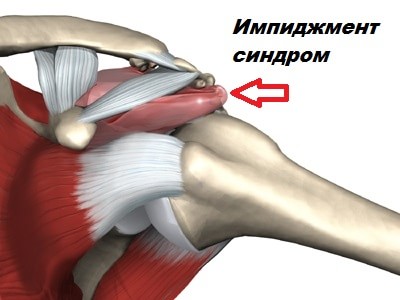 Плечолопатковий синдром причини, симптоми і лікування