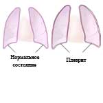 Pleurisia etiologie, patogeneza, semne clinice, curs, modificări pathoanatomice,