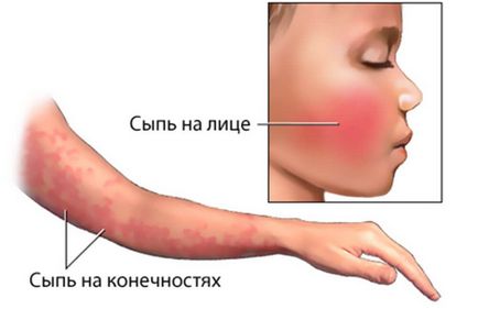 Erupții polimorfe pe piele cum să recunoască eritemul multiform