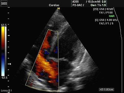 Afecțiuni cardiace