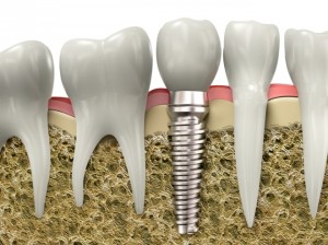 Avantajele implanturilor de zirconiu, toate știrile din stomatologie