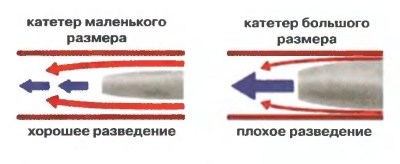 Принципи вибору венозного доступу та розміру катетера