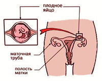 Ознаки позаматкової вагітності - енциклопедія народної медицини